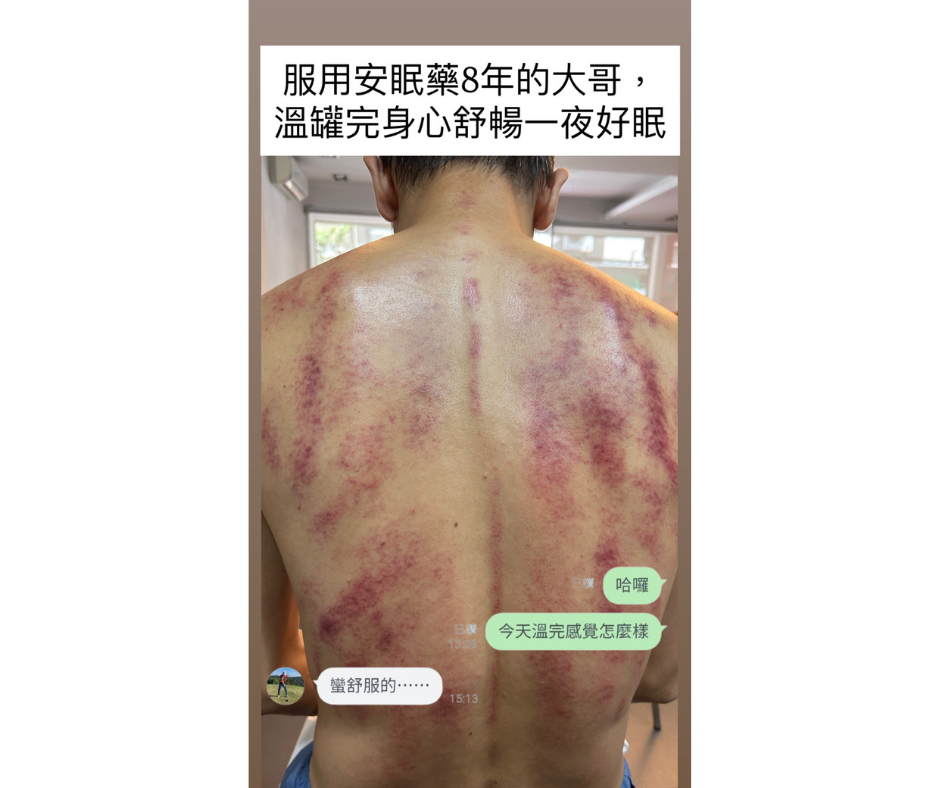 Mugwort Thermal Cupping Therapy 艾草溫罐 $1200/h