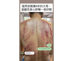 Mugwort Thermal Cupping Therapy 艾草溫罐 $1200/h